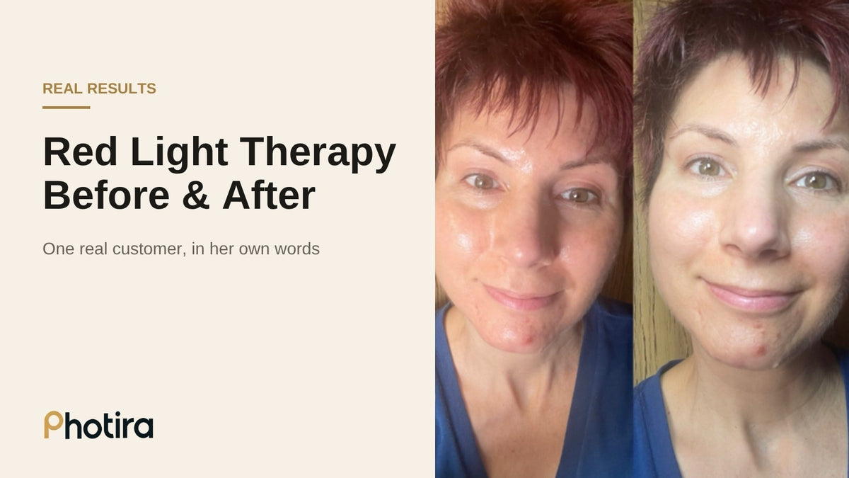 Red light therapy before and after: one real customer's results